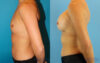 Breast Augmentation case #6273 slider thumbnail