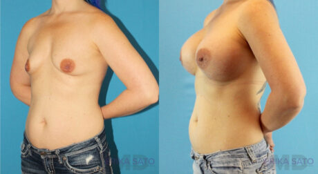 Breast Augmentation case #6268