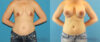 Breast Augmentation case #6268 slider thumbnail