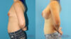 Breast Augmentation case #6268 slider thumbnail