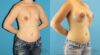 Breast Augmentation case #6268 slider thumbnail