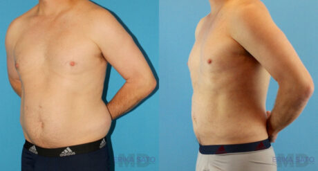 Liposuction case #5965