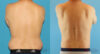 Liposuction case #5965 slider thumbnail