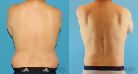 Liposuction case #5965