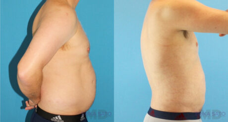 Liposuction case #5965