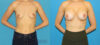 Breast Augmentation case #6279 slider thumbnail