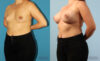 Breast Augmentation case #6285 slider thumbnail