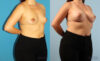 Breast Augmentation case #6285 slider thumbnail