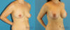 Breast Augmentation case #6291 slider thumbnail