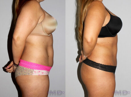 Liposuction case #5828