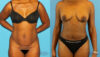 Tummy Tuck case #7341 slider thumbnail