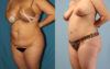 Tummy Tuck case #7342 slider thumbnail