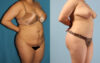 Tummy Tuck case #7342 slider thumbnail