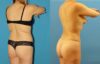 Tummy Tuck case #7343 slider thumbnail