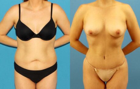 Tummy Tuck case #7343