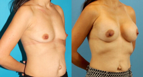 Breast Augmentation case #6309