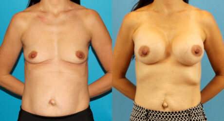 Breast Augmentation case #6309