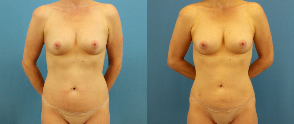 Fat Grafting to the Breast case #256188