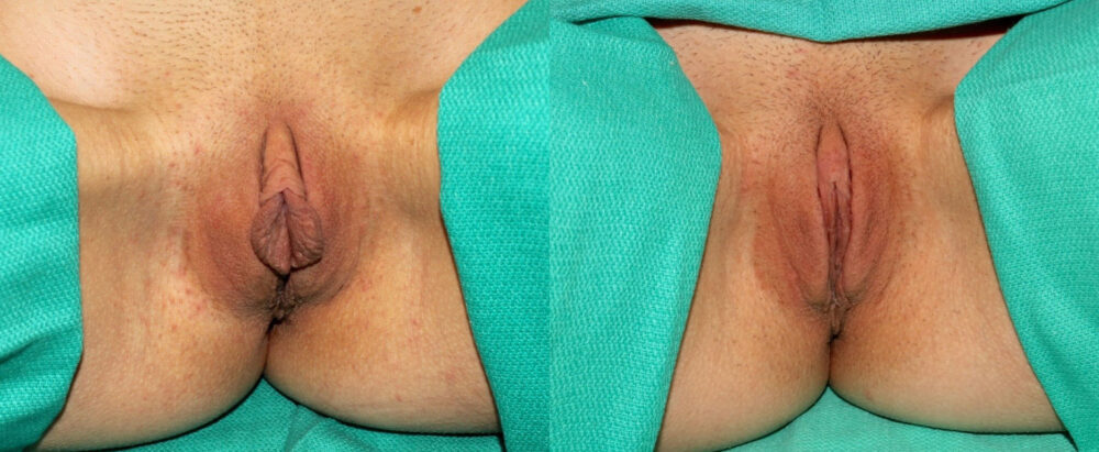 Labiaplasty case #5755