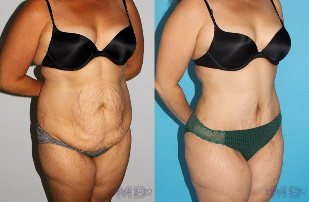 Tummy Tuck case #7165