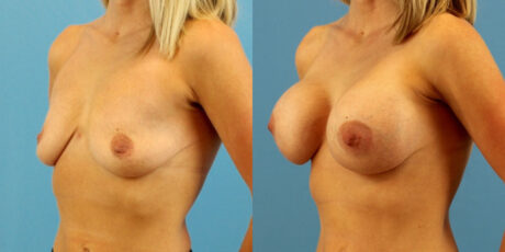 Breast Augmentation case #6333