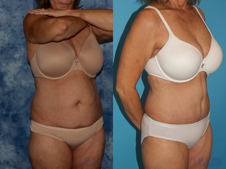 Tummy Tuck case #7086