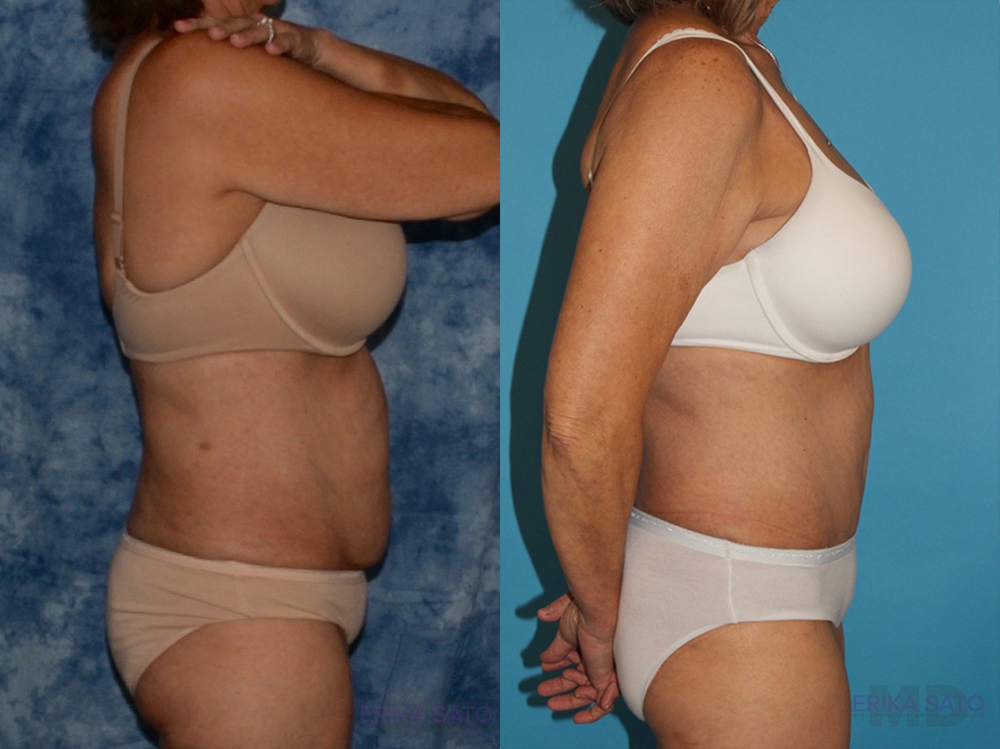 Tummy Tuck case #7086