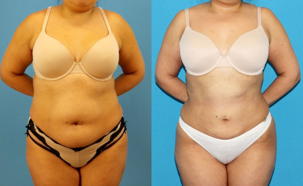 Liposuction case #6010