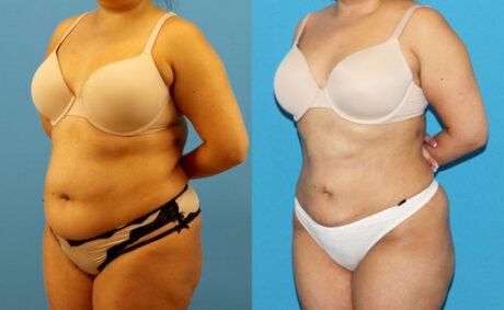 Liposuction case #6010