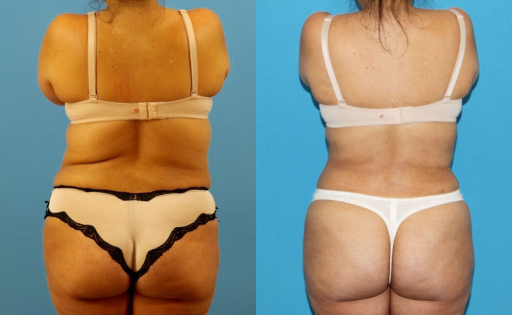 Liposuction case #6010