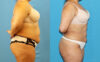 Liposuction case #6010 slider thumbnail