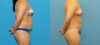 Liposuction case #6011 slider thumbnail