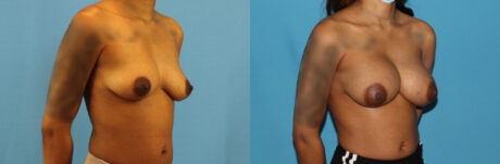 Breast Augmentation case #6346