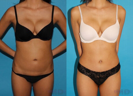 Tummy Tuck case #7231