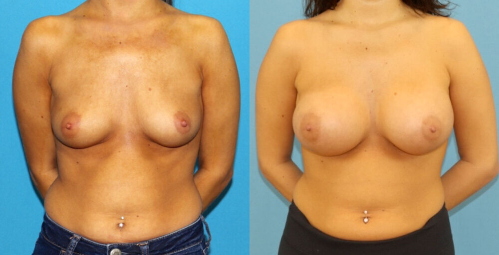 Breast Augmentation case #6352