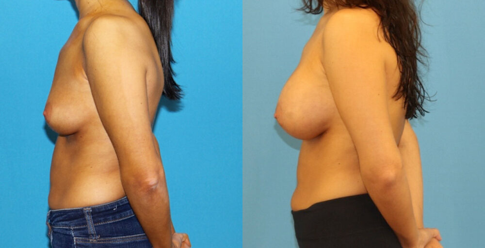 Breast Augmentation case #6352