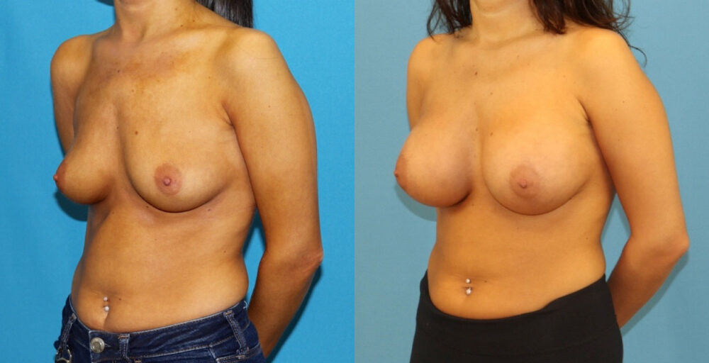 Breast Augmentation case #6352