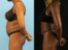 Liposuction case #6012 slider thumbnail