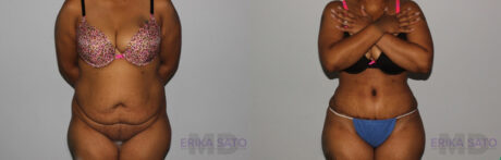 Tummy Tuck case #7083