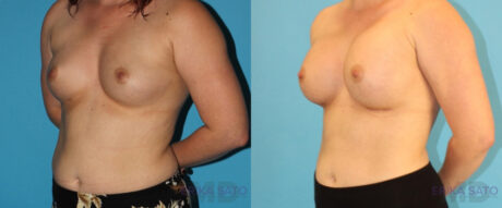 Breast Augmentation case #5644