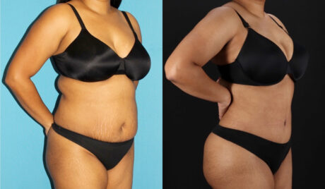 Tummy Tuck case #7349