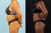 Liposuction case #6013 slider thumbnail