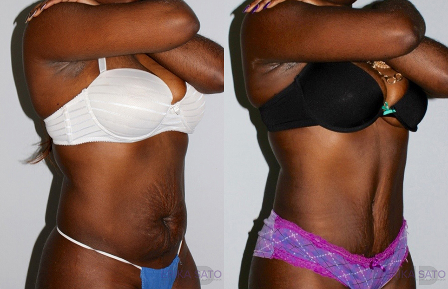 Tummy Tuck case #7163