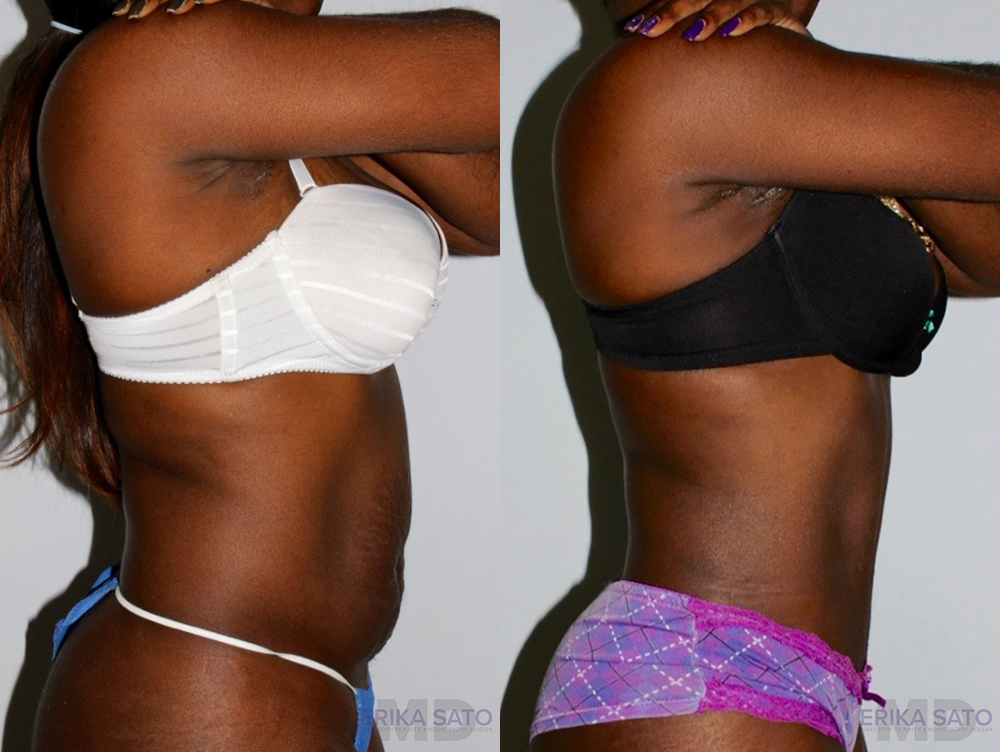 Tummy Tuck case #7163