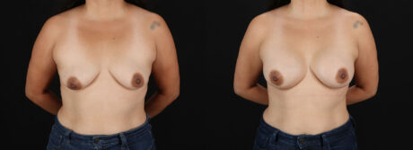 Breast Augmentation case #6497