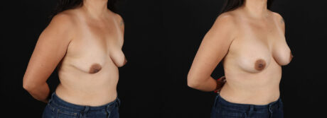 Breast Augmentation case #6497