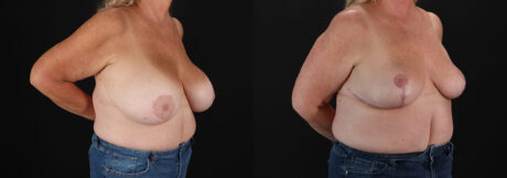 Revision Breast Surgery case #256288