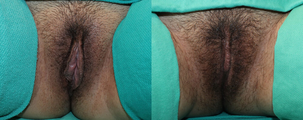 Labiaplasty case #5814