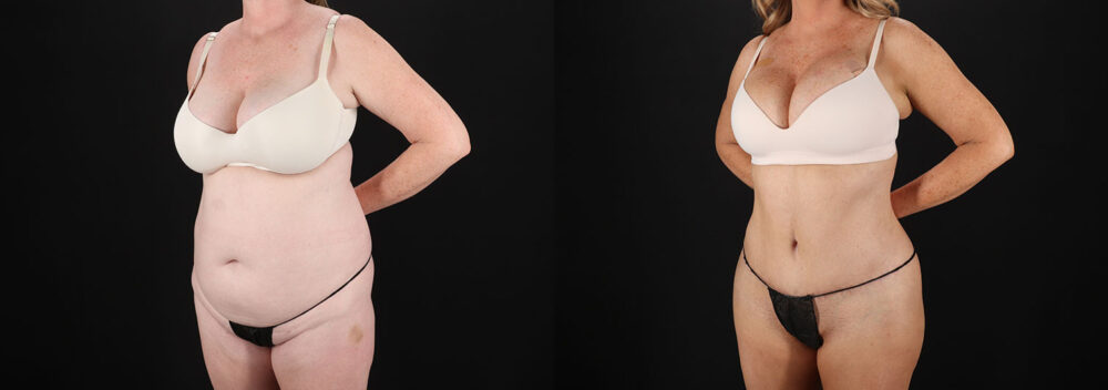 Tummy Tuck case #7779