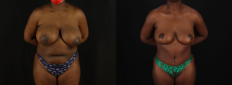 Tummy-Tuck-Before-and-After-Photo-by-Dr.-Erika-A.-Sato-in-Houston-TX-2582163-1-768×281